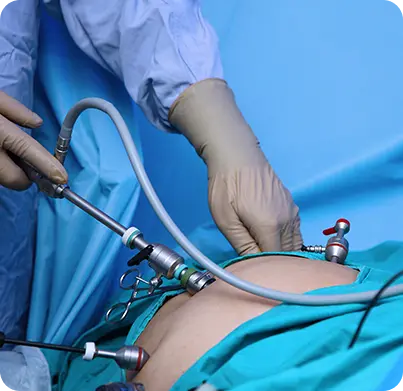 Laparoscopic Surgery